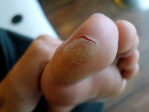 How to prevent blisters - Hikers often get blisters on toes